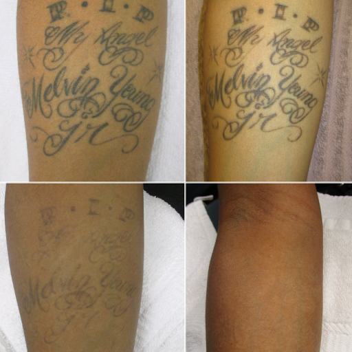 Houston Tattoo Removal Clinic
