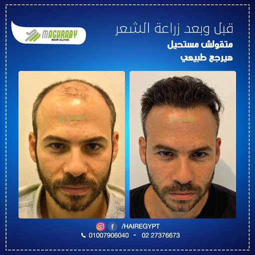 عيادات المغربي لزراعة الشعر في مصر HairEgypt.net