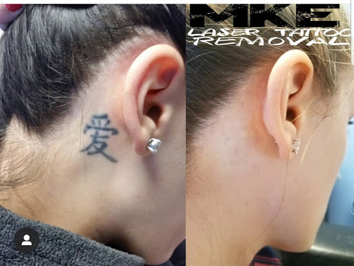 MKE Tattoo Removal