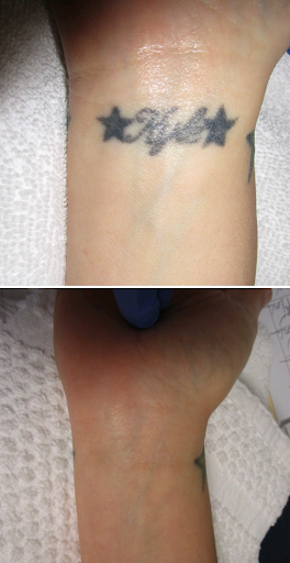 Explore sleeve cover up tattoo ideas, creative tattoo ideas in Houston, available at Houston Tattoo Removal Clinic