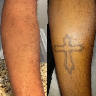 Find are hand tattoos a bad idea for your next unique tattoo in Winter Park at Winter Park Tattoo Removal