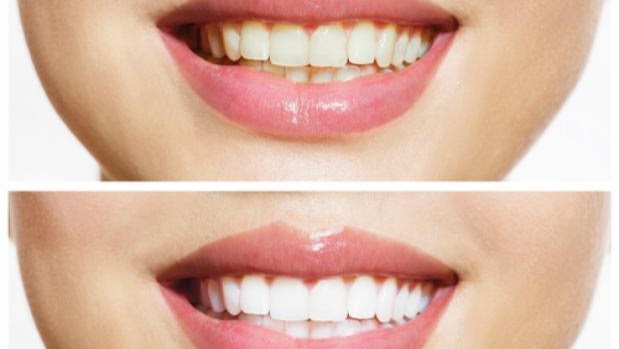 Bleach&Smile Zahnkosmetikstudio - Schönheitssalon