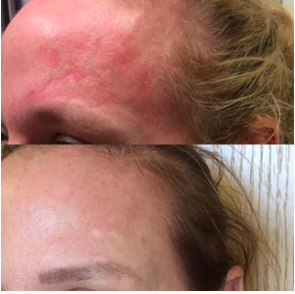 Explore spiritual 444 tattoo ideas, creative tattoo ideas in Lake Oswego, available at Lake Oswego Vein and Aesthetic LOVA