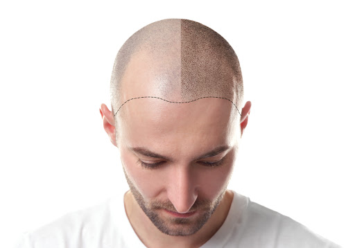 Hair Loss Solution SMP