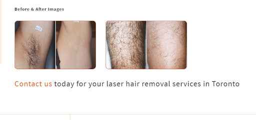 Leeza's Laser Hair Removal Clinic