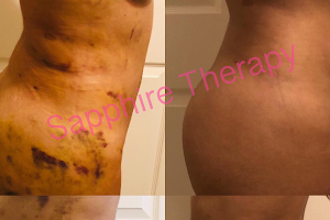 Sapphire After Lipo Therapy Sunrise: Lymphatic Drainage Center image
