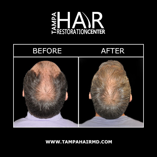 Hair Replacement Service «Tampa Hair Restoration Center», reviews and photos, 6730 W Linebaugh Ave #101a, Tampa, FL 33625, USA