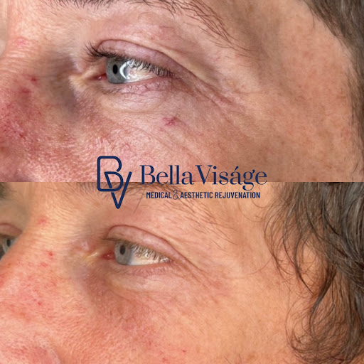 Explore my hero academia tattoo ideas, creative tattoo ideas in Lakeland, available at Bella Visge Medical & Aesthetic Rejuvenation