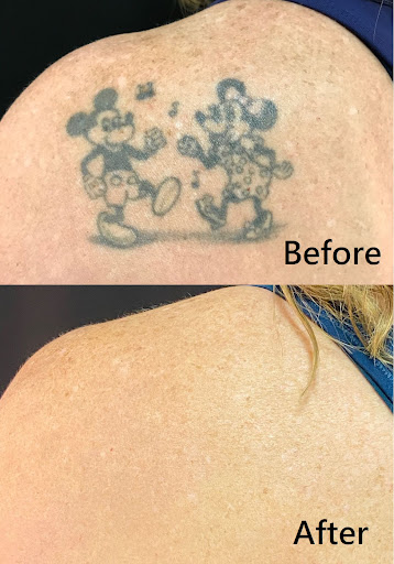 Explore oakland raiders tattoo ideas, creative tattoo ideas in Brookfield, available at Milwaukee Laser & Body Aesthetics