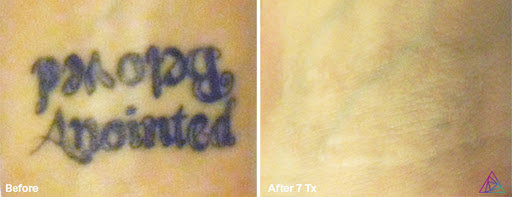 Explore frame tattoo ideas, creative tattoo ideas in Fort Myers, available at Laser Tattoo Removal by Tatt Cemetery