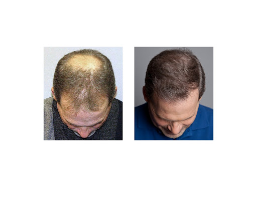 Hair Transplantation Clinic «Bosley Medical - Atlanta», reviews and photos, 3379 Peachtree Rd NE #800, Atlanta, GA 30326, USA