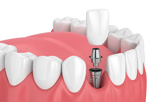 Periodontics and Dental Implants