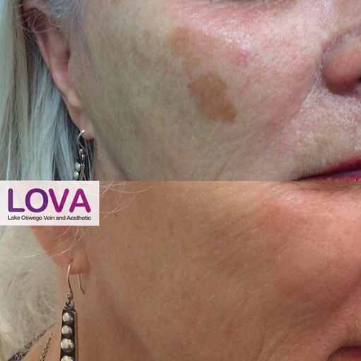 Explore ocean wave tattoo ideas, creative tattoo ideas in Lake Oswego, available at Lake Oswego Vein and Aesthetic LOVA