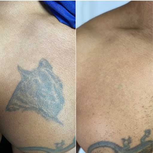 Explore love hate tattoo ideas, creative tattoo ideas in Mcallen, available at Regenerate Laser