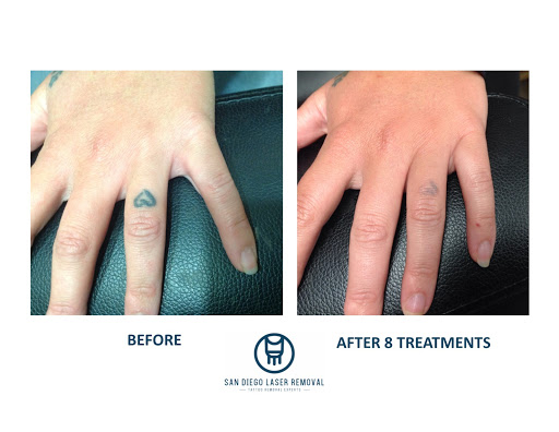 Explore rubber ducky tattoo ideas, creative tattoo ideas in San Diego, available at Removery Tattoo Removal & Fading