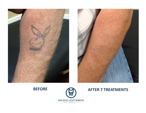 Explore female neck tattoo ideas, creative tattoo ideas in San Diego, available at Removery Tattoo Removal & Fading