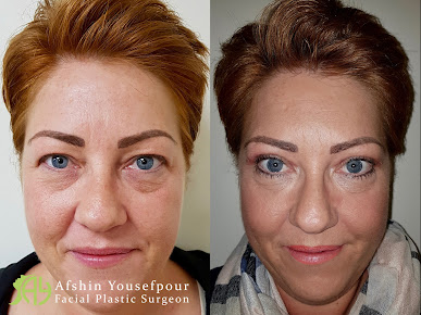 Afshin Yousefpour جراح تجميل الوجه - Afshin Yousefpour Facial Plastic Surgeon