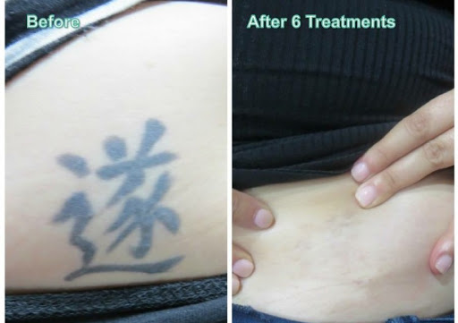 Explore san francisco tattoo ideas, creative tattoo ideas in Middle Village, available at Bye Bye Ink Laser Tattoo Removal