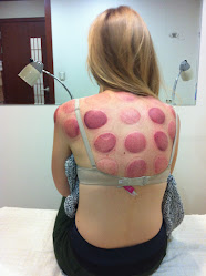 Keep Fit( Acupunture Cupping Massage)