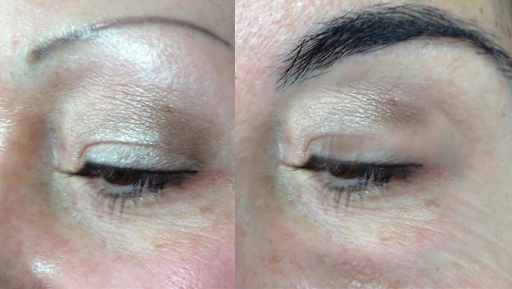 Eyebrow Hair Transplant Clinic