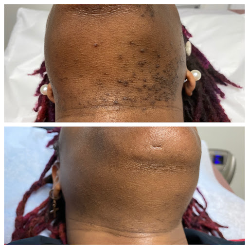 Explore gucci tattoo ideas, creative tattoo ideas in Raleigh, available at ExcelLase