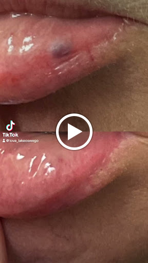 Explore hyena tattoo ideas, creative tattoo ideas in Lake Oswego, available at Lake Oswego Vein and Aesthetic LOVA