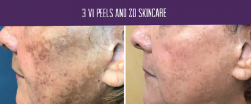 Explore butterfly tattoo color ideas, creative tattoo ideas in Baton Rouge, available at Louisiana Laserderm