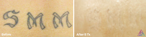 Explore 2nd tattoo ideas, creative tattoo ideas in Fort Myers, available at Laser Tattoo Removal by Tatt Cemetery