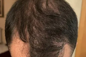 Trapianto Capelli Milano o Turchia CapilClinic image