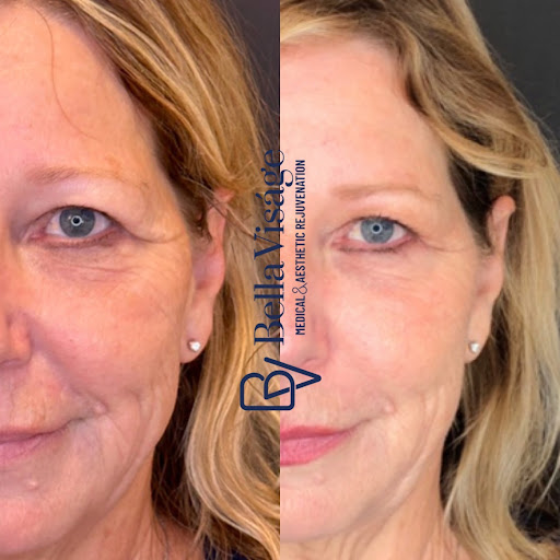 Explore chiefs tattoo ideas, creative tattoo ideas in Lakeland, available at Bella Visge Medical & Aesthetic Rejuvenation