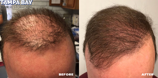 Hair Replacement Service «Tampa Bay Hair Restoration», reviews and photos, 1266 Turner St b, Clearwater, FL 33756, USA