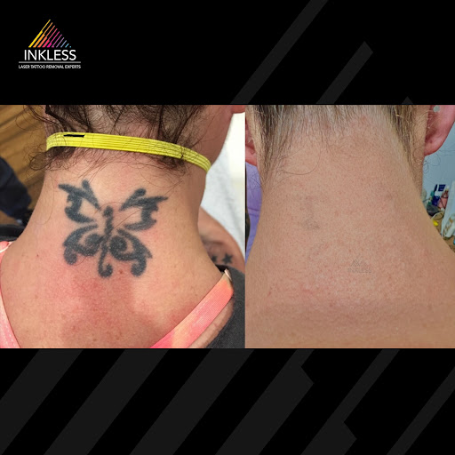 Explore partial sleeve tattoo ideas, creative tattoo ideas in Denver, available at Inkless Tattoo Removal