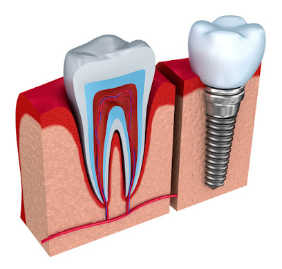 Dental Implant Clinic