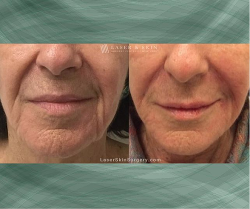 Explore fishing hook tattoo ideas, creative tattoo ideas in Southampton, available at Laser & Skin Surgery Center of New York - Southampton