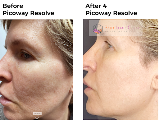 Explore chest and arm tattoo ideas, creative tattoo ideas in Bayside, available at Laser Goddess