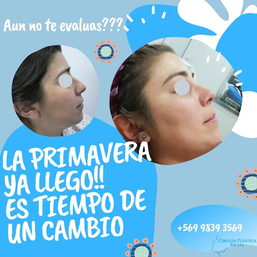 Plastica Facial Chile - Cirujano plástico