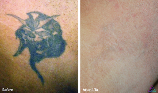 Explore bird family tattoo ideas, creative tattoo ideas in Rowlett, available at Bonsai Laser Tattoo Removal