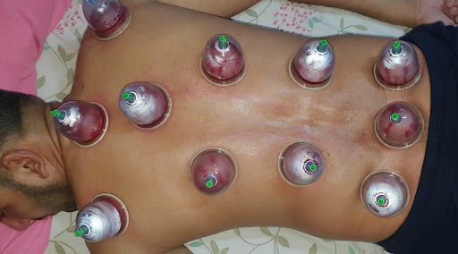 كيروبراكتيك والحجامة الإسلامية-Chiropractic and Islamic cupping