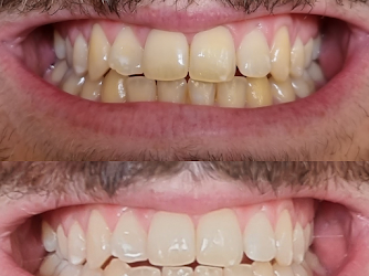 Bright Bar Teeth Whitening