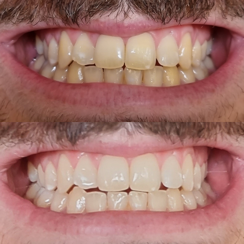 Bright Bar Teeth Whitening