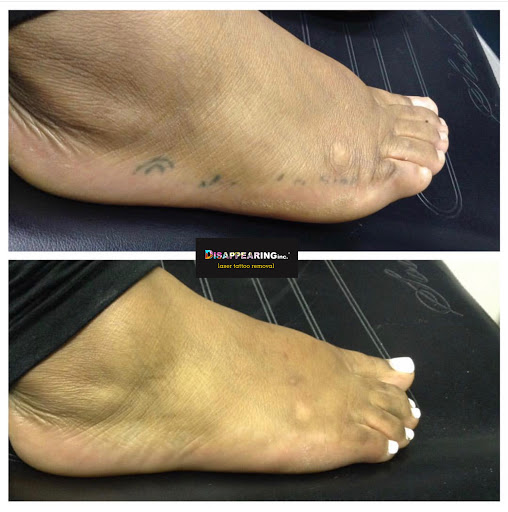 Explore hxh tattoo ideas, creative tattoo ideas in Northampton, available at Removery Tattoo Removal & Fading