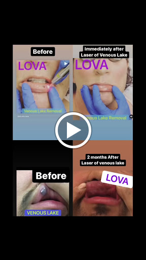 Explore chicken tattoo ideas, creative tattoo ideas in Lake Oswego, available at Lake Oswego Vein and Aesthetic LOVA