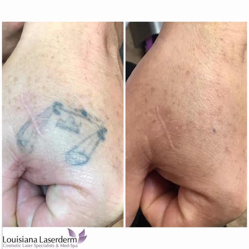 Explore excalibur tattoo ideas, creative tattoo ideas in Baton Rouge, available at Louisiana Laserderm