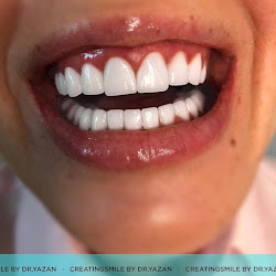 Creating Smile by Dr.Yazan Aq • Fatete dentare Emax • Implanturi dentare Bucuresti • Fatete ceramice dinti Emax CAD • coroane dentare • coronite ceramica • recomandari VIP • Hollywood Smile veneers