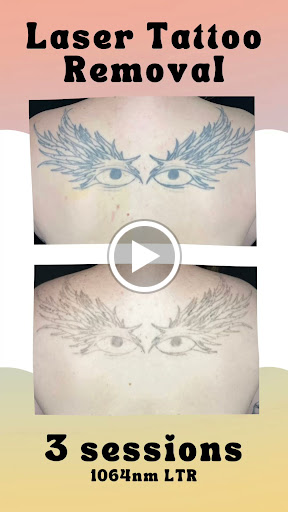 Explore self harm tattoo ideas, creative tattoo ideas in Portland, available at Take It Off Tattoo Removal and Alt Spa