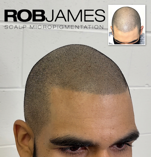 Vancouver SMP | Advanced Scalp Micropigmentation Artist - Rob James