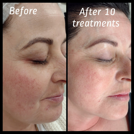 Explore boston red sox tattoo ideas, creative tattoo ideas in Brighton, available at Tip of the Spear Laser Esthetics