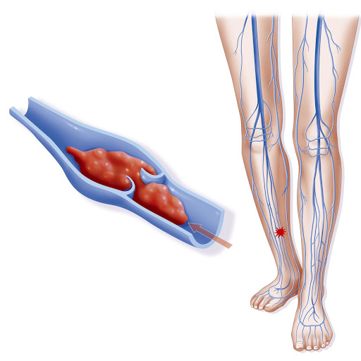 Tratamiento De Varices Quito Ecuador Cirujano Vascular Dr F. Pérez Guerrero