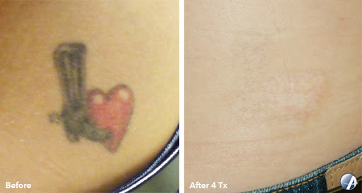 Explore skydiving tattoo ideas, creative tattoo ideas in Joplin, available at Blacklist Laser