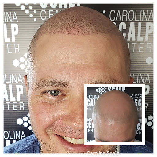Carolina Scalp Center/Scalp Micropigmentation